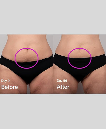 SickScience DropOff Advanced Exosome Body Firming & Sculpting Cream | Targets Stretch Marks, Cellulite, the Belly Area & Loose Skin, Including After Pregnancy, 100ml