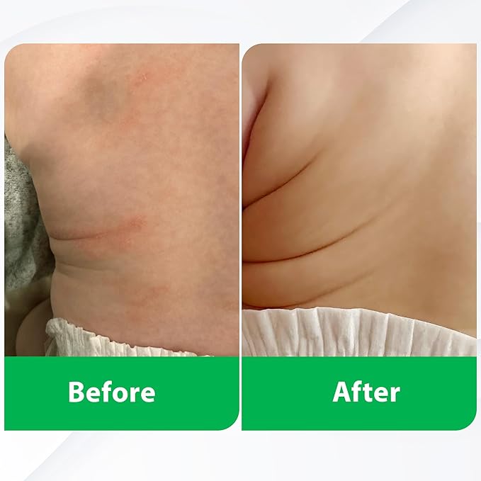 Manuka Honey Cream - Eczema Cream for Adults & Kids - Seborrheic Dermatitis Cream for All Skin Types - Eczema Honey Cream for Redness & Itch Skin Relief with Aloe Vera - 4oz
