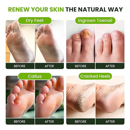 FOOT CURE Tea Tree Oil Foot Soak with Epsom Salt - Best Toenail Fungus Treatment, Athletes Foot & Softens Calluses - Soothes Sore & Tired Feet, Fungal Toe, Foot Odor Scent, Spa Pedicure (Pack of 2)