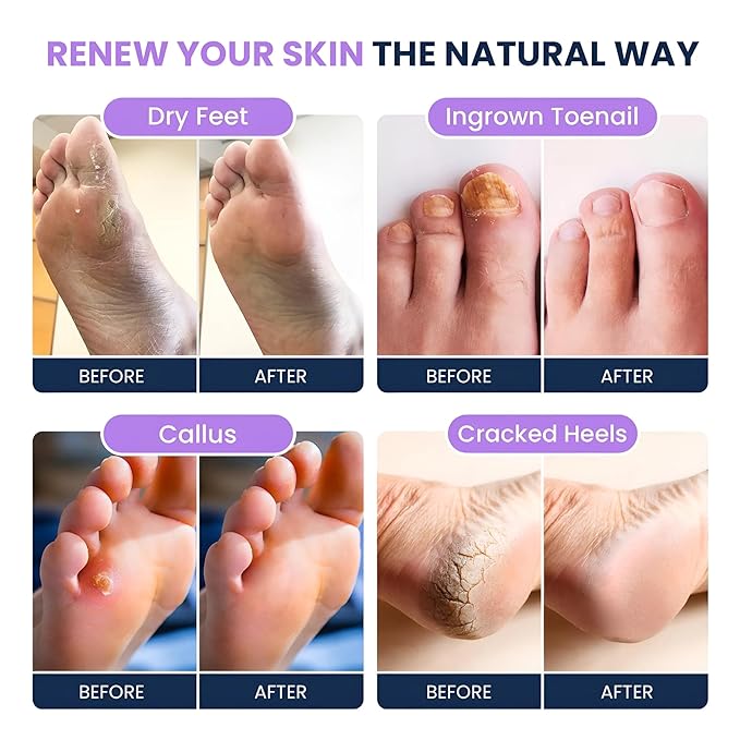 FOOT CURE Premium Epsom Salt Foot Soak - Tea Tree Oil Foot Soak for Athletes - Relaxing Foot Bath with Fungal Support - Foot Soaking Salts & Oils - Soothing for Tired Feet & Calluses (Pack of 4)
