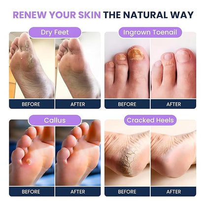 FOOT CURE Premium Epsom Salt Foot Soak - Tea Tree Oil Foot Soak for Athletes - Relaxing Foot Bath with Fungal Support - Foot Soaking Salts & Oils - Soothing for Tired Feet & Calluses (Pack of 4)