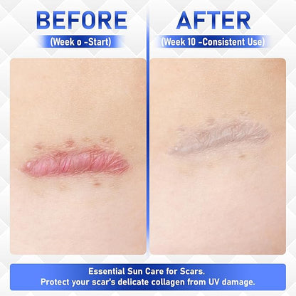 Silicone Scar Cream Gel - [3.53 oz / 100g] Jumbo Value Pack - Advanced Gel for Old & New Scars, C-Section, Stretch Marks, Surgery, Acne, Burns, Keloids - Face & Body