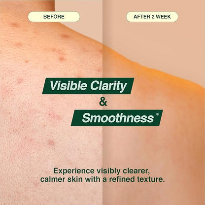Tea Tree 90 Clear Body Mist for acne skin | 360° Moisture Spraying with Vegan Formula | AHA+BHA+PHA+LHA, Korean Skincare (6.76 fl oz, 200ml)