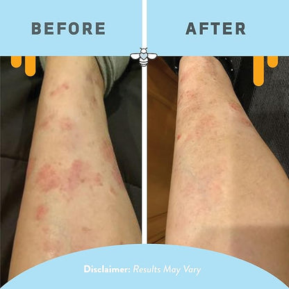 PSORIASIS HONEY Daily Moisturizing Body Lotion - Eczema & Seborrheic Dermatitis Cream for Itchy & Flaking - Moisturizing Psoriasis Treatment for Skin (16oz)