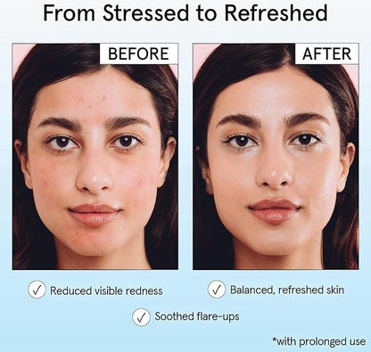 grace & stella Hypochlorous Acid Spray for Face - Acne Spray - Gentle Face Mist to Calm Redness, Flare-Ups, Breakouts, Body Acne, Bacne - Soothing Facial Mist for Sensitive Skin (120ml/4 fl oz)
