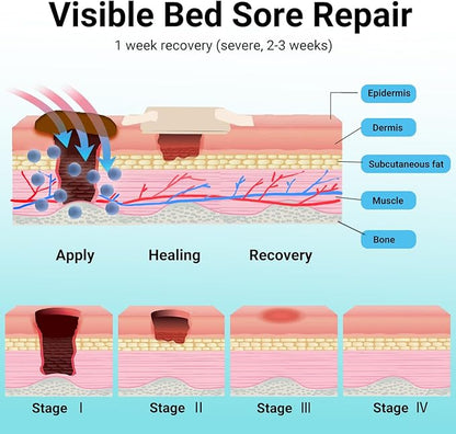 ishancare® Bed Sore Cream - Fast & Safe Natural Healing Pressure Sore Cream, Bedsore Wound Care Healing Ointment, Treatment for Bed sores Pressure Sores Diabetic Ulcer Wounds Burns and Cuts