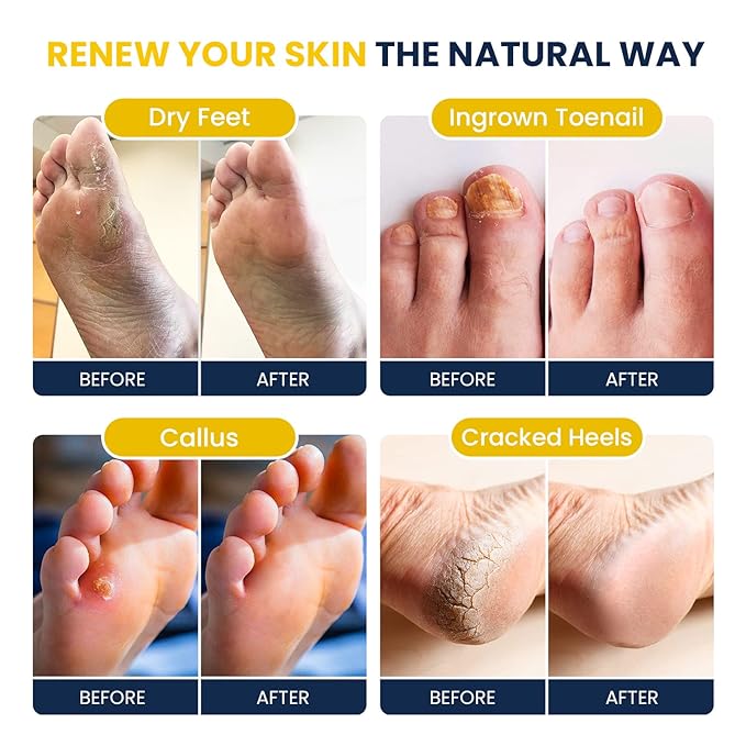 FOOT CURE Citrus Detox Foot Soak With Epsom Salts for Foot Callus, Immune Boost, Damaged Toenail, Athletes Foot, Pedicure and Soothes Tired Aching Feet - 16 oz (Pack of 2)