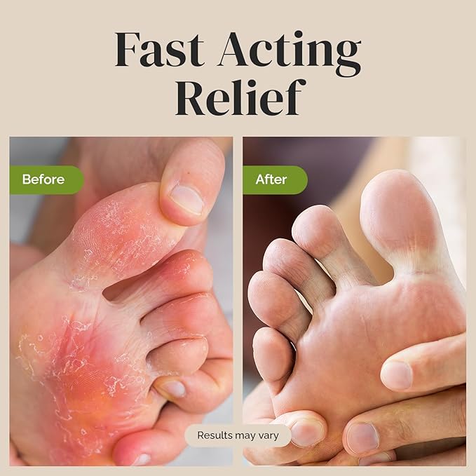 Puriya Clinically Proven Antifungal Cream for Skin Fungus, Extra-Strength Athletes Foot Cream Treatment, Jock Itch, Ringworm Treatment for Humans, Anti Fungal Itchy Skin Relief with Tea Tree Oil