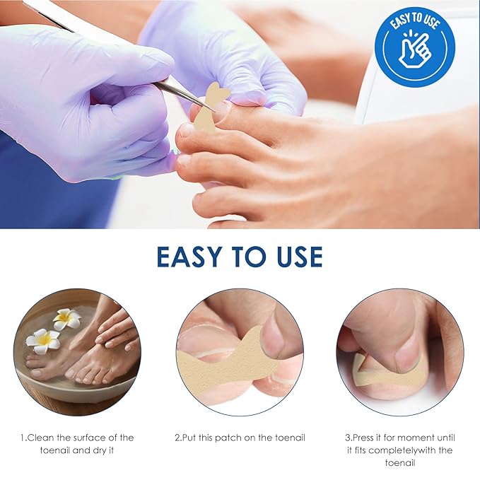 Ingrown Toenail Treatment, 50Pcs Breathable Ingrown Toenail Corrector Patches with Nail File & Lifter, Professional-Grade Treatment for Fast Results