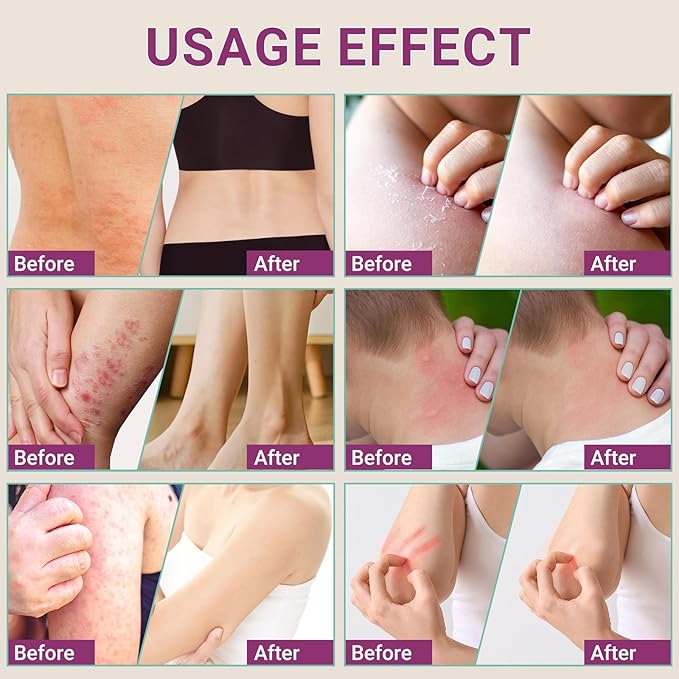 Anti Itch Cream, Extra Strength Anti-Itch Ointment, Relieves Rashes and Itching Caused by Insect Bites, Sunburns, Pet Hair, Dust Contact Allergies, and Poison Ivy, Poison Oak, and Poison Sumac 3.53OZ