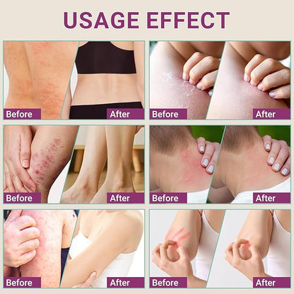 Anti Itch Cream, Extra Strength Anti-Itch Ointment, Relieves Rashes and Itching Caused by Insect Bites, Sunburns, Pet Hair, Dust Contact Allergies, and Poison Ivy, Poison Oak, and Poison Sumac 3.53OZ
